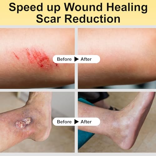 Manuka Honey for Wounds, Speed up Healing for Cuts, Surgical Wounds, Scars, Foot Ulcers, Infection, Burns, Non-Sticky, No Crystallization, Easy to Apply, 3.88 oz