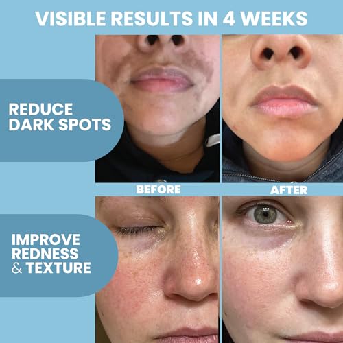 Azelaic Acid 10% Facial Serum ? With Niacinamide, Hyaluronic Acid ? Lightweight Face Serum ? 2 oz