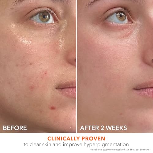 Dr Dennis Gross Alpha Beta¢ç 2% BHA+ Breakout Solution, Minimizes Pores, Clear & Prevent Breakouts, 5 Fl Oz
