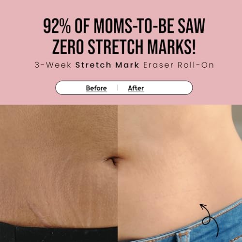 Cos-IQ Stretch Marks Removal Roll-On Serum with Striover | Scar Removal | Uneven Skin Tone | All Skin Types | 40ml