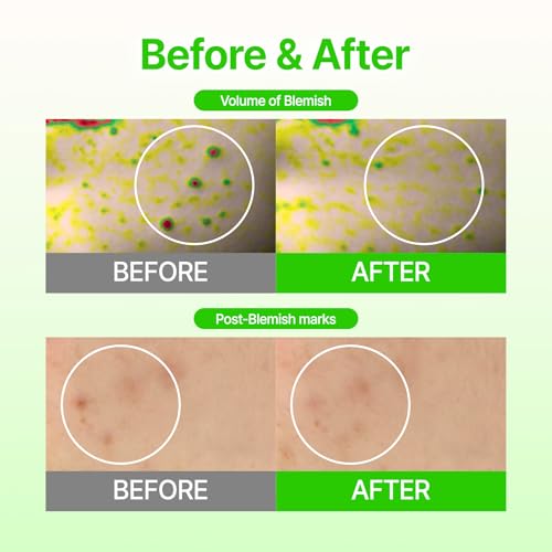 Acropass Microcone Pimple Patch Blemish Care - Post-Blemish, Redness, Dark Spot, Niacinamide, Dermatologist Tested, Non-Irritating, Cruelty Free (8 Count)