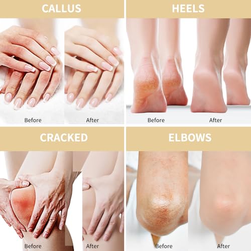 Grocerism Urea Cream 50 Percent for Feet 5.29 oz with Oat and 2% Salicylic Acid, Foot & Hand Cream included Hyaluronic Acid, Tea Tree and Aloe Vera for Deep Moisturizing, Callus Removing 2 Packs