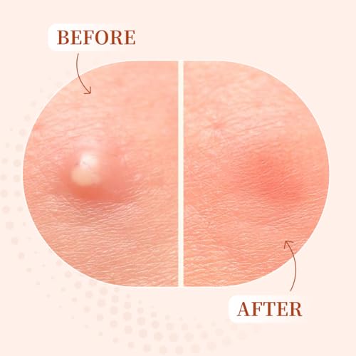 Pimple Patches for Face (96 Count) ? Invisible Hydrocolloid Acne Patches with Tea Tree & Salicylic Acid ? Waterproof Zit Stickers for Overnight, Makeup & Sensitive Skin