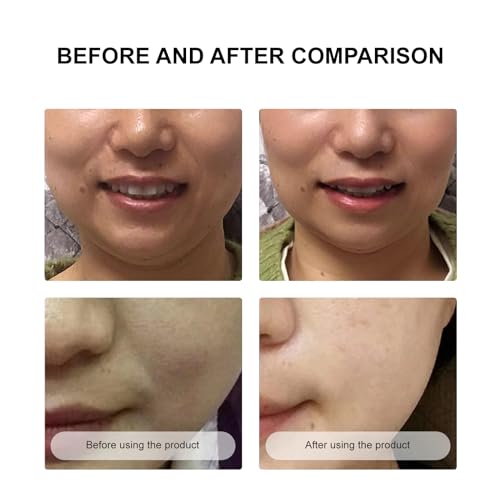 Sheet Face Masks Skincare to Remover Smile Lines, Laugh Lines Anti Wrinkle Patches,Face Lift Beauty & Facial Skin Care Products