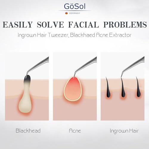 Pro Blackhead Tweezers for Nose & Face ? Precision Ingrown Hair & Blackhead Removal Tool, Stainless Steel, Professional Comedone Tweezers for Men & Women