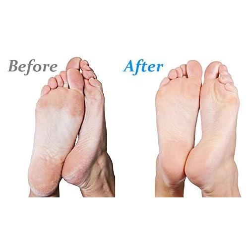 Emjoi Micro-Pedi 3D POWER Callus Remover with Xtreme Coarse Soft & Flexible Roller (Most Powerful & Corded)