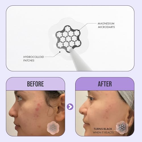 Magnesium Blemish Microdarts | Pimple Patch | Cystic Acne | Fast-Acting | Quick Calming | 99.9% Pure Magnesium | Madecassic Acid | Tea Tree | Eucalyptus Leaf | Hydrocolloid Spot Care