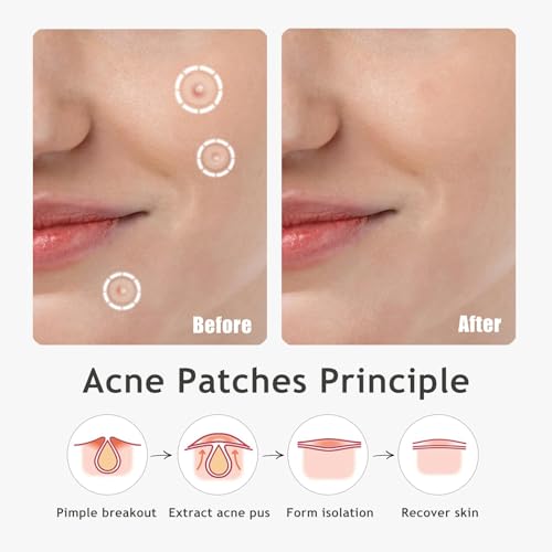 Ultra Pimple Patch Variety Pack Hydrocolloid Pimple Patches with Salicylic Acid for Covering Small & Large Zits and Blemishes, Spot Stickers for Face and Skin (36 Counts)