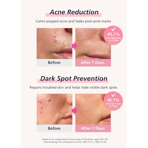 Easyderm Real Calming Patch Pimple Patches, Niacinamide, Hyaluronic Acid, EGF, K-Beauty Skincare | 10 Packs (60 Total) Micro Point length : 285¥ìm