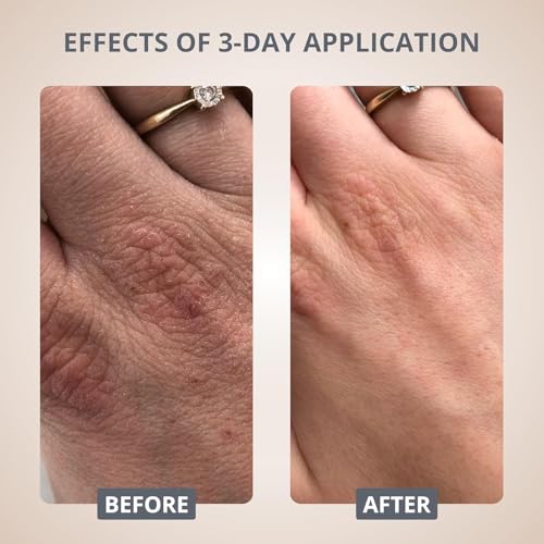 swederm Hudsalva Sensitive Eczema Hand Cream 3.38 Oz - Soothing and Moisturizing Hands and Foot Cream - Healing Ointment with Glycerine - Nourishes & Repair for Dry Skin and Callus - Quickly Absorbing