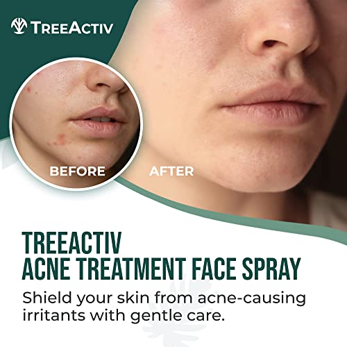 Acne Face Spray, 4 fl oz Facial Spray with Witch Hazel, Salicylic Acid for Acne Prone and Oily Skin, for Hormonal, Severe Cystic Acne, Skin Clearing Toner, 1000 Sprays