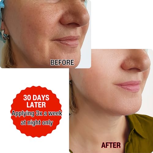 gymsegb? 20% Glycolic + 10% Lactic Acid AHA Chemical Peel ? Professional Facial Exfoliant with 3% Hyaluronic Acid for Texture, Dark Spots & Pores ? Fragrance?Free, Sensitive Skin & Melanin?Safe - 30ml