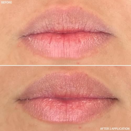 RescueMD Restorative Lip Treatment, Peptide-Powered Rejuvenation + Arnica Repair for Healthy, Hydrated Lips (12mL)
