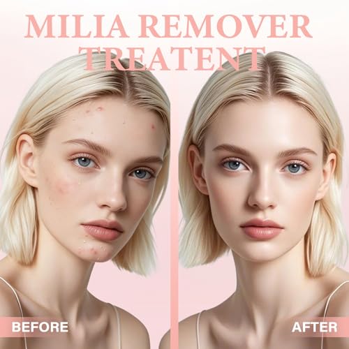 Milia Control Serum, Improve Skin Radiance Lightweight, Oil-Free Formula for Eyes & Face