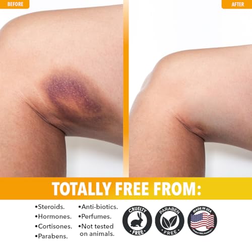 Dr. Robaina Arnica Bruise Cream 4 oz ? Concentrated Arnica & Vitamin K Moisturizer for Skin That Looks More Even After Bumps & Cosmetic Touch-Ups ? Fast-Absorbing, Non-Greasy, Made in USA