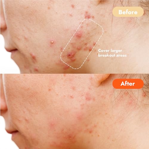 Epielle Over-Zit XL Acne Clear Patches | Ultimate Hydrocolloid Solution | 14 Extra-Large Pimple and Blemish Patches