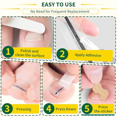 Small Size-Titanium Alloy Ingrown Toenail Treatment & Removal Kit for Quick Relief, Ingrown Toenail Removal Kit£¬ Professional Ingrown Toenail Corrector, Ingrown Toenail Tools for Quick Relief, 10 Pcs