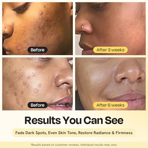 Gleamin Superactive Vitamin C Serum for Face - 15% Vitamin C with Niacinamide, Bakuchiol & Hyaluronic Acid - Brightening Facial Treatment for Uneven Tone, Dark Spots & Radiant Glow - 1 fl oz