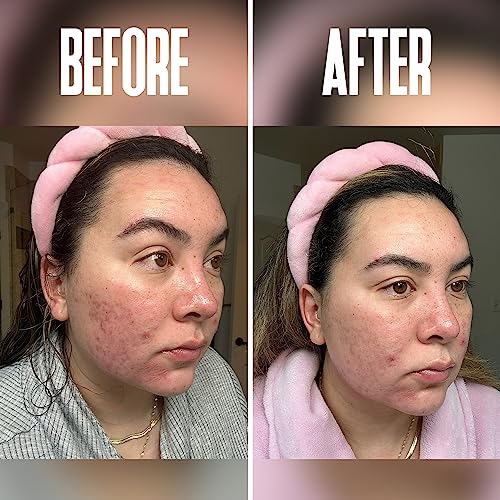 Anti Aging Skin Care Set: Glycolic Acid Peel 70% & Glycolic Resurfacing Pads - This Ultra Potent Duo Will Purify Your Skin & Eliminate Wrinkles, Acne Scarring For an Ultra Clear & Glowing Complexion