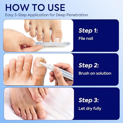 Nail Fungus Treatment Extra Strength: 25% Undecylenic Acid Formula - Toenail Fungus Treatment Kit with 5 Pens & Nail File for Ingrown Nails, Discoloration & Brittle Nails