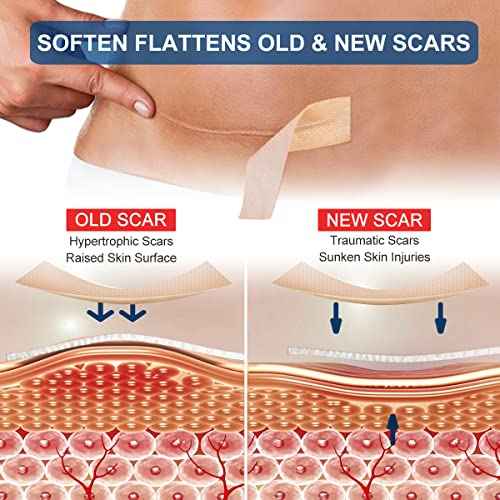 Silicone Scar Sheets (1.6¡± x 120¡± Roll-3M), Silicone Scar Tape Roll, Scar Silicone Strips, Reusable, Professional Scar Removal Sheets for C-Section, Surgery, Burn, Keloid, Acne et