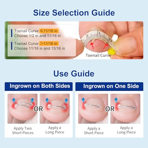 Nitinol Ingrown Toenail Corrector,at Home Ingrown Toenail Treatment,Curved Toenail Straightener,Ingrown Toe Nail Relief£¬Ingrown Toenail Removal Kit (1/2 In,11/16 In)