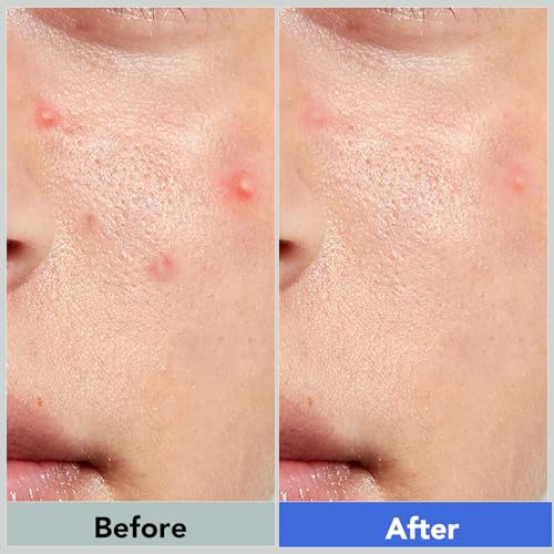 Pimple Patches for Face,Acne Patches for Face,Pimple Patch,Zit Patches,Hydrocolloid Blemish Patches for Covering Zits,with Salicylic Acid,Tea Tree oil & Calendula oil (360 Counts, Count, 360)