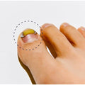 Ingrown Toenail Treatment & Corrector with Latex Elasticity - Curved Toenail Straightener | Effective Daily Solution for Ingrown Toenail Pain & Growth Correction [S/0.67inches/16-18mm]