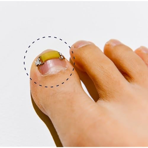Ingrown Toenail Treatment & Corrector with Latex Elasticity - Curved Toenail Straightener | Effective Daily Solution for Ingrown Toenail Pain & Growth Correction [S/0.67inches/16-18mm]