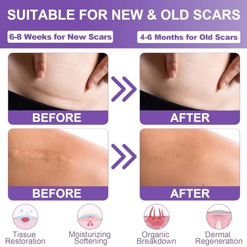Silicone Scar Sheets, Medical Grade Silicone Scar Tape (1.6" x 60"), Professional Scar Removal Treatment, Reusable, for Healing Keloids, Surgeries Scars, C-sections, and Burns