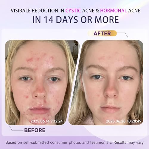 Nip + Fab Glycolic Fix Night Pads Extreme (60 Count) ? 5% Glycolic Acid Exfoliating Face Pads with Salicylic Acid ? Resurfacing AHA BHA Chemical Peel for Blemishes & Texture