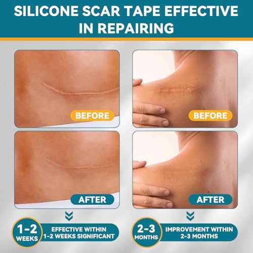 Silicone Scar Tape for Surgical Marks Face Stick Keloid Cover C-Section Strips Wrinkle Cream Lip Sleeping Gel Sheet Tummy Patch Hydrocolloid Roll Soft (1 Pack, 1.6"X 120")