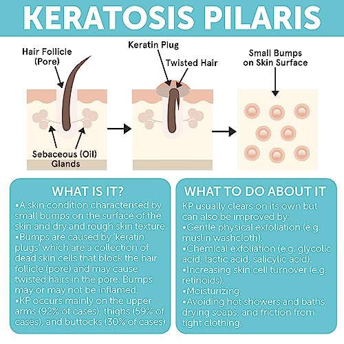 Body Soap for Keratosis Pilaris | Exfoliating Soap Scrub with 10% AHA & Micro Pumice Beads | Buffingbar for Smooth Skin, Strawberry Legs, Ingrown Hair & Razor Bumps | Bar Soap for Men and Women 4.2 oz