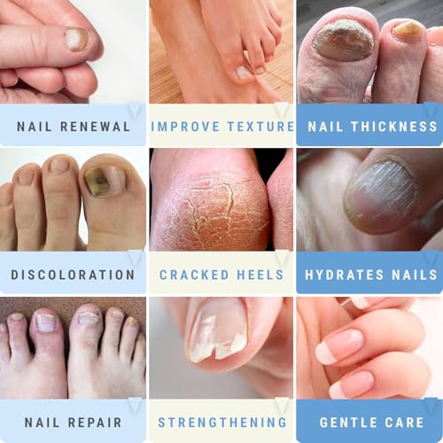 Urea Nail Gel Combo Pack ? 50% Urea Daily Treatment & CLEAR 40% Urea Night Gel with Tea Tree Oil ? Softens Thick Nails, Repairs Cracked Heels, Whitens Discolored Nails ? Quick-Dry ? Made in USA