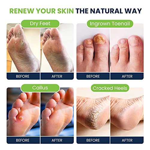 Tea Tree Oil Foot Soak with Epsom Salt - Best Toenail Fungus Treatment, Athletes Foot & Softens Calluses & Toenail Repair Solution