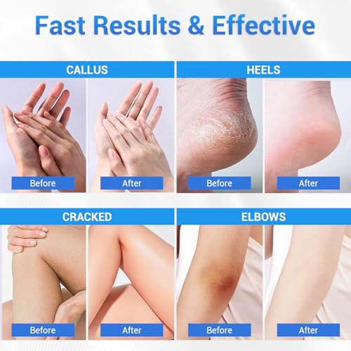 2Pairs Moisturizing Socks and Urea Cream 40 Percent