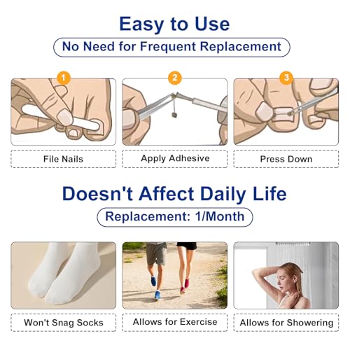 Nitinol Ingrown Toenail Corrector,at Home Ingrown Toenail Treatment,Curved Toenail Straightener,Ingrown Toe Nail Relief£¬Ingrown Toenail Removal Kit (1/2 In,11/16 In)