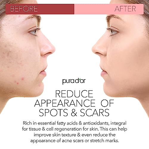 PURA D'OR ORGANIC Rosehip Seed Oil Hair Relaxer (4 Oz x2 = 8 Oz) 100% Pure Cold Pressed USDA Certified All Natural Anti-Aging, Scar Treatment, Gua Sha Massage, Face, Hair & Skin - Women & Men
