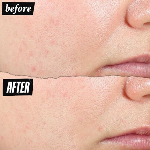 Kiehl's Expertly Clear Moisturizer with 1.2% Salicylic Acid & 2% Niacinamide, Hydrating Acne Treatment, Fades Post-acne Marks, Corrects Uneven Texture & Tone, Prevents Future Breakouts - 2 fl oz