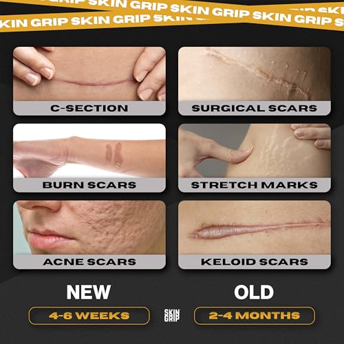 Skin Grip Medical Grade Silicone Scar Tape 1.6"x120" Roll - Increased Strength & Reduced Irritation - Silicone Scar Sheets For Face, Surgical Scars, C-Section, Keloid Treatment, Tummy Tuck, Burn, Acne