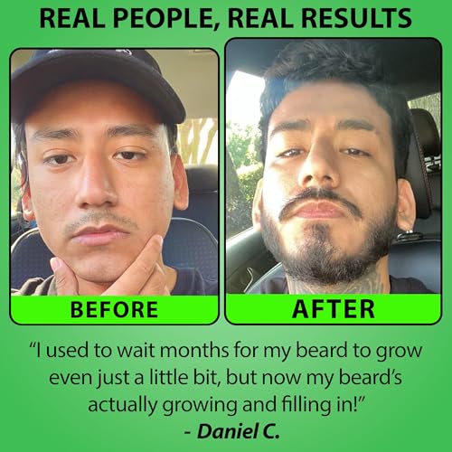 Minoxidil for Beard Growth ? 5% Serum with 2X Biotin & Rice Water, Promotes Thicker, Fuller Facial Hair, Ideal for Patchy Areas, Revitalizes Follicles