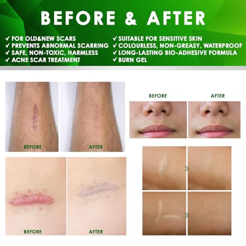 Advanced Keloid Bump Removal Gel: Silicone Keloid Scar Removal Cream for Scars from Piercing, Surgical Marks, Acne, and Burns, Keloid Treatment for Ears, Face, and Body with Healing Formula 30g
