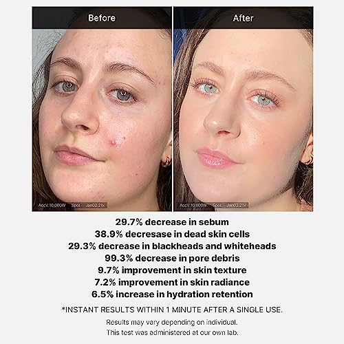 Medicube 21% Acid Wash-off Exfoliant (AHA+BHA+Succinic Acid), Wash-off Resurfacing Serum, Best for bumpy, breakout-prone skin, Korean Skincare (1.41fl.oz.)
