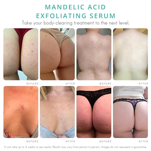 Almond Clear Level 2 Serum | Mandelic Acid Body Serum for Acne, Folliculitis, Aging Skin, Ingrown Hairs, Dark Spots on Face, Chest, Butt, Back, Thighs, Arms | 4 oz
