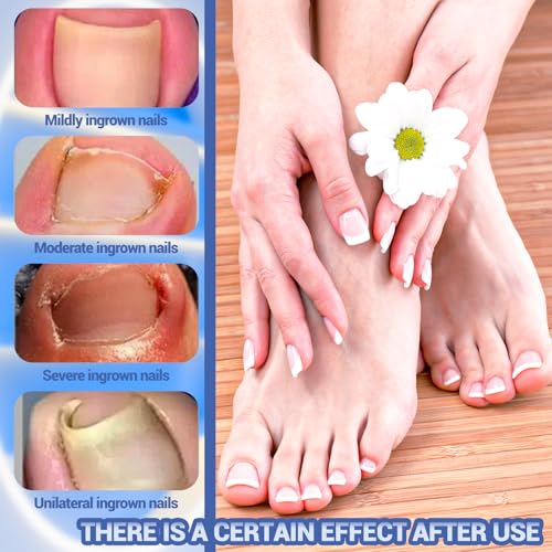 Toenail Fungus Treatment Extra Strength, Ingrown Toenail Treatment, 80 Pcs Glue-Free Breathable Corrector Patches, Professional Ingrown Toenail Tools, Not Prone to Falling Off, with File