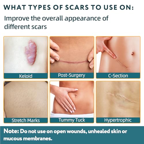 Silicone Scar Tape - 60" x 1.6" Roll - 1.5M, Scar Treatment for Improves Surgical, Keloid, Hypertrophic Scars - Medical Grade Reusable Silicone Scar Sheets