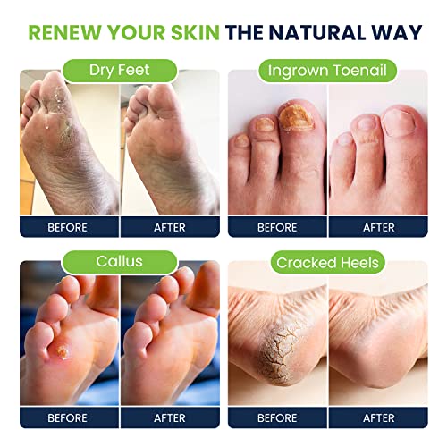 Tea Tree Foot Soak, Callus Remover Gel - Extra Strength Callus Remover Gel & Foot Soak With Epsom Salts For Calluses & Tea Tree Oil Foot Balm/ Moisturizer For Dry Cracked Feet