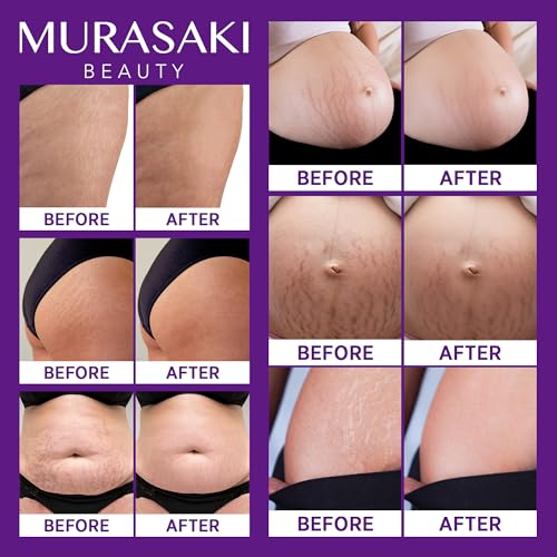 Stretch Mark Cream Prevention for Pregnancy - Maternity Cream for Stretch Marks Removal | Nourishing Formula ? Prevents Stretch Marks & Improves Elasticity - 4 oz (120g) (2 Pack)