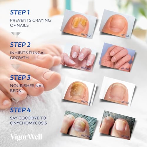 Toenail Fungus Treatment Extra Strength - Nail Fungus Treatment For Toenail Extra Strength - Nighttime Nail Patches & Nail Treatment Liquid Set (32patches+15ml)