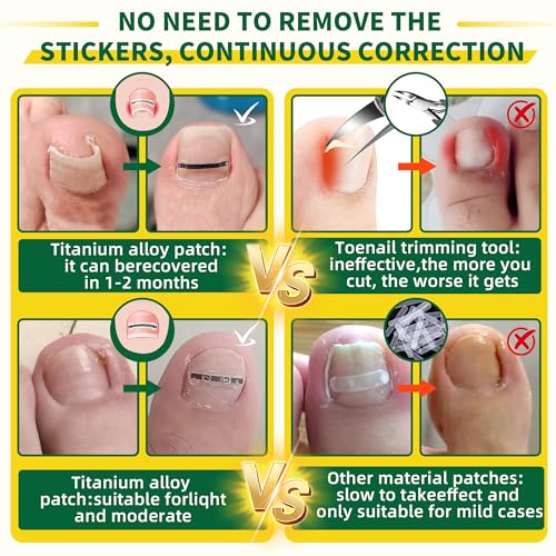 Small Size-Titanium Alloy Ingrown Toenail Treatment & Removal Kit for Quick Relief, Ingrown Toenail Removal Kit£¬ Professional Ingrown Toenail Corrector, Ingrown Toenail Tools for Quick Relief, 10 Pcs